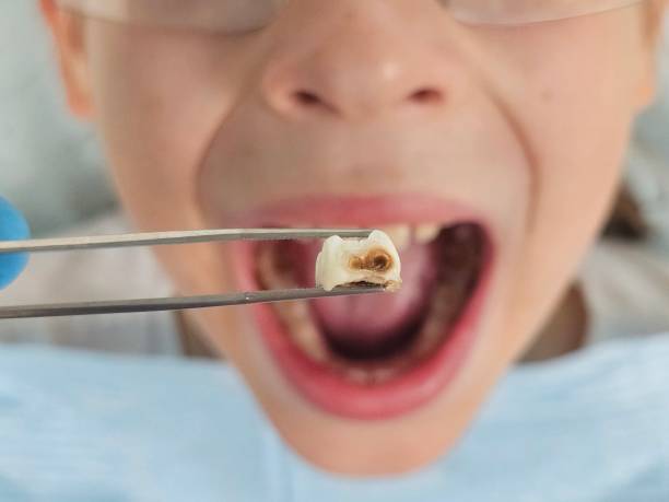 Best Emergency Dental Extractions in Ckam Housing, HI